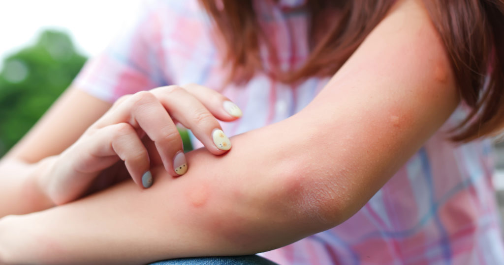 pourquoi les boutons de moustiques grattent sur le bras de la jeune fille